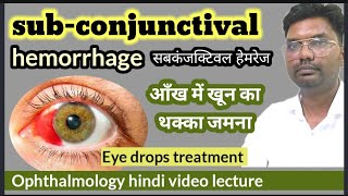 subconjunctival hemorrhage  subconjunctival hemorrhage treatment  सबकंजक्टिवल हेमरेज [upl. by Aneles]