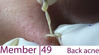 Acne Treatment Huong Da Nang 049  weekend  2023 [upl. by Gut]