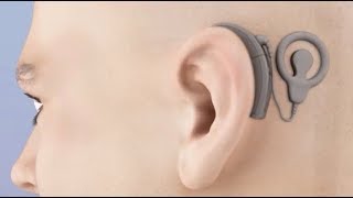 Cochlear Implant Animation [upl. by Ashly]