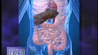 What is Diverticulitis Video [upl. by Eal]