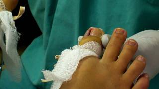 Ingrown Toenail Removal [upl. by Brainard]