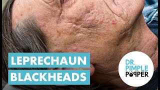 Blackhead Blackheads amp Blackheads Extended Leprechaun Blackheads [upl. by Delmer]