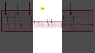 Atrial Trigeminy ecg ecginterpretation medicine doctor cardiology medicalstudent nurse [upl. by Vidal]