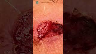 What is squamous cell carcinoma  Shorts [upl. by Bertsche]