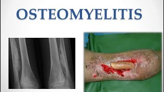 Bone and Joint Infection  Osteomyelitis  Medicine  MisMedicine [upl. by Reinhard]