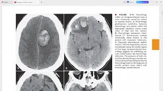 BRAIN IMAGING EXPERT RADIOLOGY SERIES [upl. by Pharaoh315]