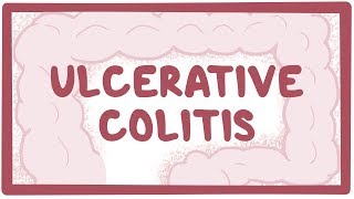 Ulcerative colitis  causes symptoms diagnosis treatment pathology [upl. by Coridon]