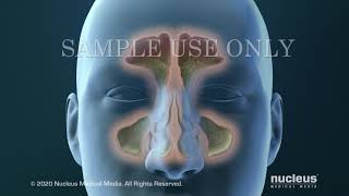 Sinusitis Surgery [upl. by Epner]