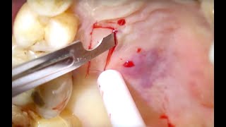 Hybrid Connective Tissue  Epithelial graft for the increase of keratinised mucosa around implant [upl. by Eleets]