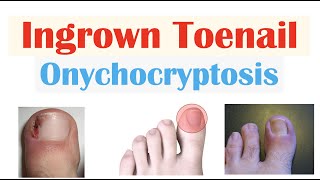 Ingrown Toenail Onychocryptosis  Causes Risk Factors Signs amp Symptoms Diagnosis Treatment [upl. by Aysahc]