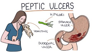 Understanding Stomach and Duodenal Ulcers [upl. by Malory]