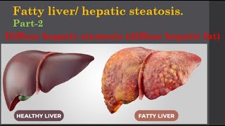 Fatty liver Diffuse hepatic steatosis diffuse hepatic fat [upl. by Airetal]