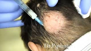 Intralesional corticosteroid injections for alopecia areata [upl. by Nywles]