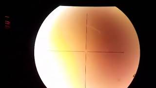 Retinal tear hole laser walgorafi1 [upl. by Pelag]