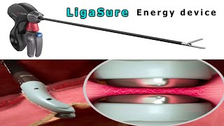 Ligasure  Bipolar energy device [upl. by Eddina]