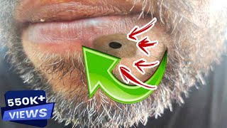 Super Satisfying Blackhead Removal2023best Blackhead RemovalBlackhead Removal [upl. by Attenohs]