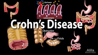 Crohns Disease Pathophysiology Symptoms Risk factors Diagnosis and Treatments Animation [upl. by Ahsil]