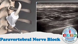 Paravertebral Nerve Block [upl. by Hoo]