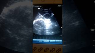 Simple Ovarian cyst medical ultrasound [upl. by Tsiuqram]