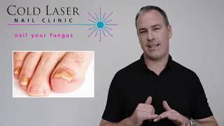 How Does Laser Toenail Fungus Removal Work [upl. by Bathsheb]