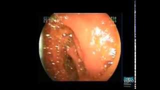 ERCP with BalloonAssisted Enteroscope in Patients with Surgically Altered Upper GI Anatomy [upl. by Ekusuy]