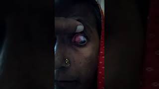 recorrent episcleritis from 2 years youtubeshorts shortvideo episcleritis eyedoctor doctor [upl. by Iviv461]