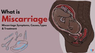 What is Miscarriage  Miscarriage Symptoms Causes Types amp Treatment  Med About You [upl. by Cohen]