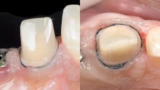 Dental basics Gingival Retraction  The two cord technique [upl. by Ynaffad]