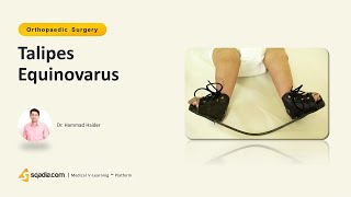 Talipes Equinovarus  Orthopedics Video Lectures  Medical Student  VLearning™ [upl. by Yalhsa]