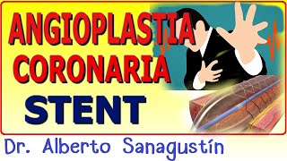 CATETERISMO CARDÍACO y ANGIOPLASTIA CON STENT ¡Lo que necesitas saber [upl. by Madeline891]