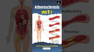 Atherosclerosis के क्या है  Causes sign and symptoms atherosclerosis testpaperlive shorts [upl. by Frydman]