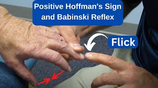 Positive Hoffmans Sign and Babinski Reflex in an MS Patient [upl. by Krall]