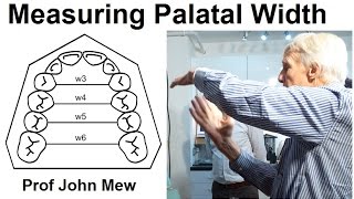 Measuring the Width of the Upper Jaw Palate Maxilla in Orthodontic Treatment by Prof John Mew [upl. by Ttelracs]