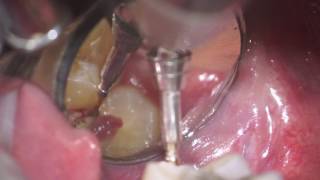 operculectomy of mx 3dr molar [upl. by Soule711]