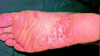 Types of Psoriasis  An Overview [upl. by Blakely618]