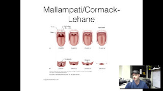 5 minute refresher Difficult Airway Assessment [upl. by Alpers]