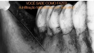 Você Sabe Como Fazer a Infiltracao Mandibular com Articaina [upl. by Marie-Jeanne]