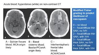 Subarachnoid Haemorrhage [upl. by Brunhild]