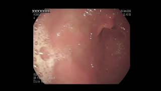 Nodular lymphoid hyperplasia in duodenum Dr Fouad Alahdab [upl. by Llednav837]