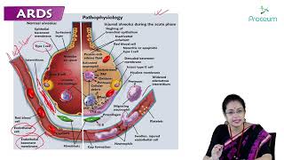 Acute Respiratory Distress Syndrome ARDS Part 1  Internal medicine 🫁🫁🫁 [upl. by Michiko]