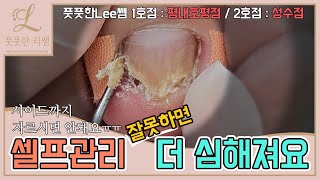 ENG SUB셀프관리 잘못하면 더 심해져요 사이드까지 자르시면 안돼요ㅠㅠ ingrown toenail  Fresh Foot 풋풋한리쌤 성수점  평내호평점 [upl. by Annabelle575]