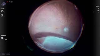 Pseudophakic retinal detachment in vitrectomized eye Vista Live Stream [upl. by Bum]