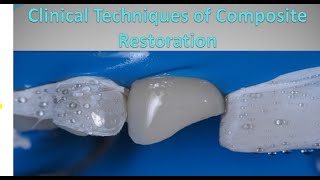 Clinical technique of composite restoration straight my teeth [upl. by Glynda]