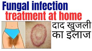 Fungal infection treatment at home  Khujli ki medicine  Daad ki best medicine [upl. by Bertie]