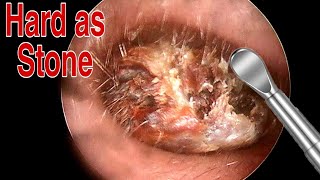 BIGGEST Ear Wax Difficult Removal  EP2  Doctor Anh [upl. by Shulem]