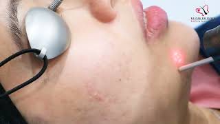 Klinik Dr Inder  Aesthetic Clinic Malaysia Hollywood Laser Peel [upl. by Vihs69]