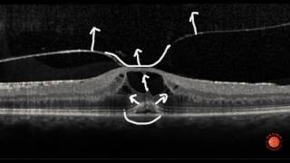 OCT Interpretation  Vitreous [upl. by Ahsela]