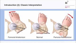 M Tannast In amp outtoeing a reliable diagnostic sign for femoral malversion Hip Symposium 2018 [upl. by Saleem]