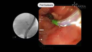 ERCP Procedure Video  Best Gastroenterologist in Bangalore  Dr Dinesh Kini  Sakra World Hospital [upl. by Sine]