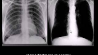 Chest xray interpretation COPD emphysema [upl. by Ahsikal]